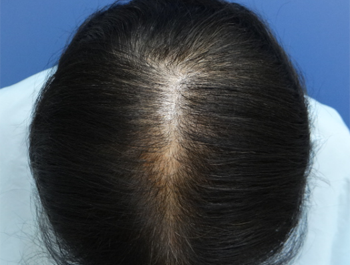 薄毛治療 発毛症例 60歳/頭頂部/初診時