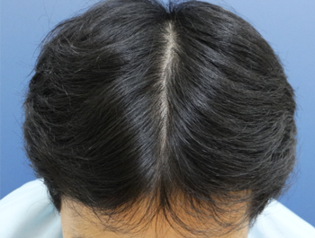 薄毛治療 発毛症例 30歳/MO型/7ヶ月後