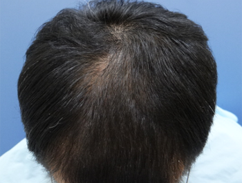 薄毛治療 発毛症例 50歳/O型/10ヶ月後