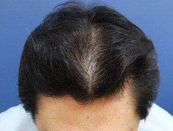 薄毛治療 発毛症例 40歳/O型/7ヶ月後