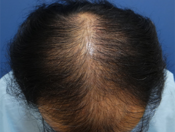 薄毛治療 発毛症例 52歳/O型/初診時
