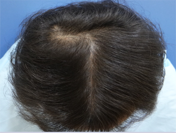 薄毛治療 発毛症例 43歳/O型/10ヶ月後
