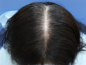 薄毛治療 発毛症例 44歳/頭頂部/初診時