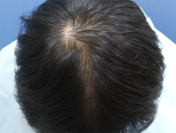 薄毛治療 発毛症例 21歳/O型/5ヶ月後