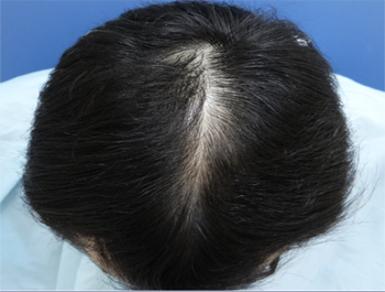 薄毛治療 発毛症例 36歳/O型/6ヶ月後