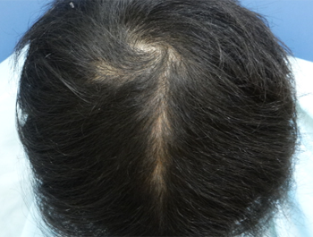 薄毛治療 発毛症例 24歳/O型/9ヶ月後