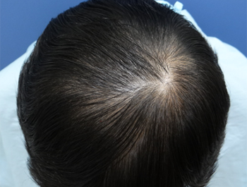 薄毛治療 発毛症例 49歳/O型/初診時