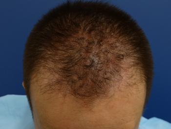 薄毛治療 発毛症例 43歳/M型/初診時
