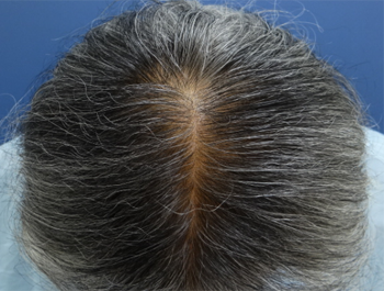 薄毛治療 発毛症例 44歳/O型/7ヶ月後