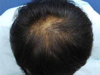 薄毛治療 発毛症例 39歳/O型/初診時