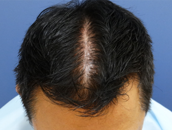薄毛治療 発毛症例 45歳/MO型/10ヶ月後