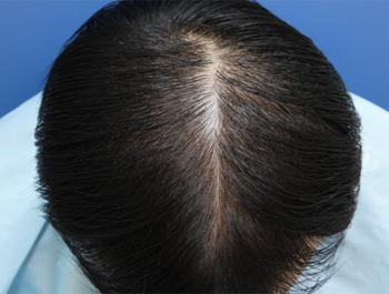 薄毛治療 発毛症例 33歳/O型/初診時