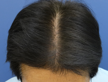 薄毛治療 発毛症例 60歳/MO型/6ヶ月後