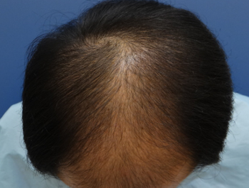 薄毛治療 発毛症例 43歳/MO型/初診時