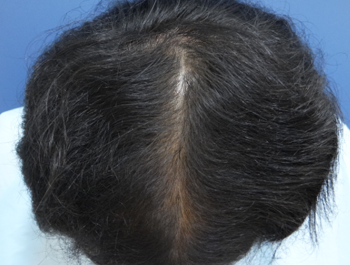 薄毛治療 発毛症例 43歳/MO型/9ヶ月後