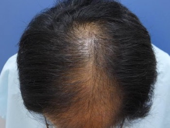 薄毛治療 発毛症例 45歳/MO型/初診時