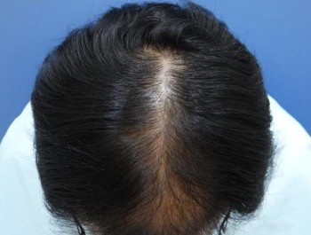 薄毛治療 発毛症例 45歳/MO型/7ヶ月後