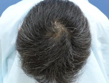 薄毛治療 発毛症例 37歳/O型/9ヶ月後