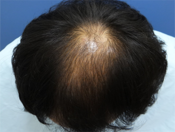 薄毛治療 発毛症例 38歳/O型/初診時
