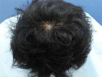 薄毛治療 発毛症例 30歳/O型/6ヶ月後