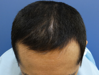 薄毛治療 発毛症例 39歳/MO型/10ヶ月後