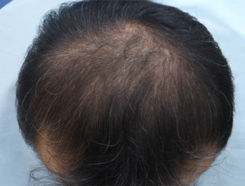 薄毛治療 発毛症例 42歳/O型/11ヶ月後