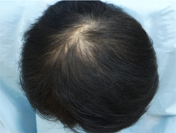 薄毛治療 発毛症例 50歳/O型/12ヶ月後