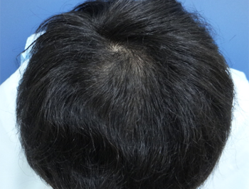 薄毛治療 発毛症例 27歳/O型/8ヶ月後