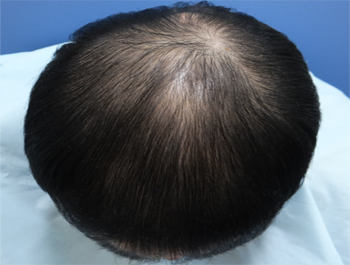薄毛治療 発毛症例 41歳/MO型/9ヶ月後