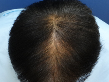 薄毛治療 発毛症例 56歳/Ⅳ型/初診時