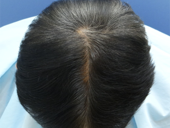 薄毛治療 発毛症例 56歳/Ⅳ型/6ヶ月後