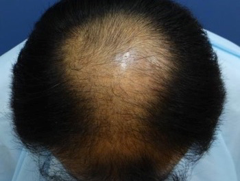 薄毛治療 発毛症例 40歳/MO型/初診時
