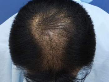 薄毛治療 発毛症例 40歳/MO型/8ヶ月後