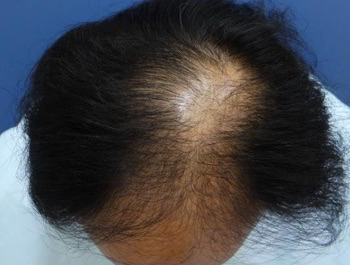 薄毛治療 発毛症例 55歳/MO型/初診時