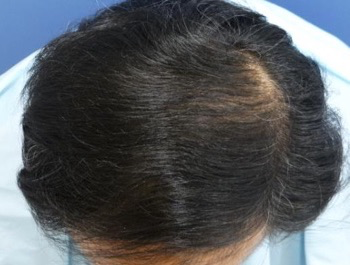 薄毛治療 発毛症例 55歳/MO型/8ヶ月後