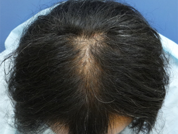 薄毛治療 発毛症例 46歳/O型/10ヶ月後