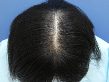 薄毛治療 発毛症例 39歳/頭頂部/初診時
