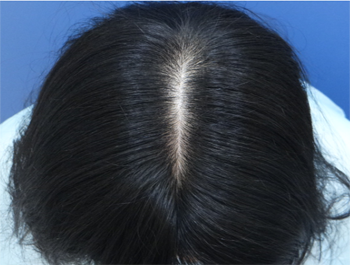 薄毛治療 発毛症例 39歳/頭頂部/6ヶ月後