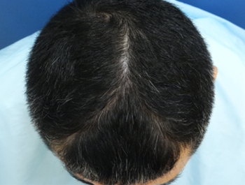 薄毛治療 発毛症例 46歳/O型/7ヶ月後