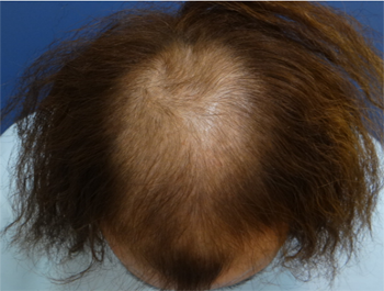 薄毛治療 発毛症例 28歳/MO型/初診時