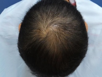 薄毛治療 発毛症例 42歳/O型/初診時