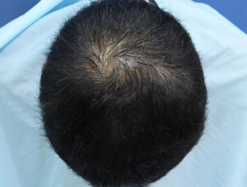 薄毛治療 発毛症例 42歳/O型/8ヶ月後