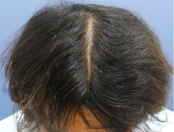 薄毛治療 発毛症例 46歳/O型/6ヶ月後
