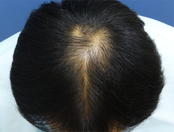 薄毛治療 発毛症例 36歳/O型/初診時