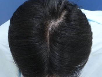 薄毛治療 発毛症例 51歳/O型/6ヶ月後