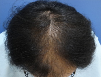 薄毛治療 発毛症例 54歳/MO型/6ヶ月後