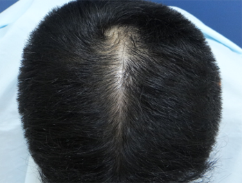 薄毛治療 発毛症例 38歳/O型/6ヶ月後