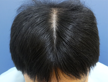 薄毛治療 発毛症例 41歳/O型/6ヶ月後