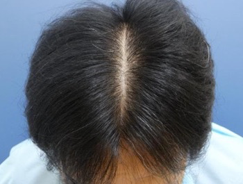薄毛治療 発毛症例 49歳/MO型/7ヶ月後