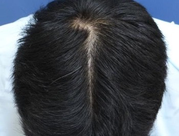 薄毛治療 発毛症例 35歳/O型/6ヶ月後